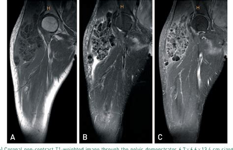 Figure 3 From Uremic Tumoral Calcinosis Around The Hip Joint In A