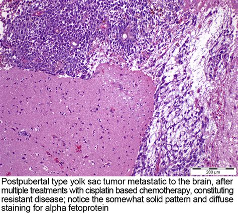 Pathology Outlines Yolk Sac Tumor