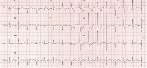 ventricular strain litfl ecg library diagnosis