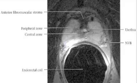 Prostate Axial Mri Anatomy