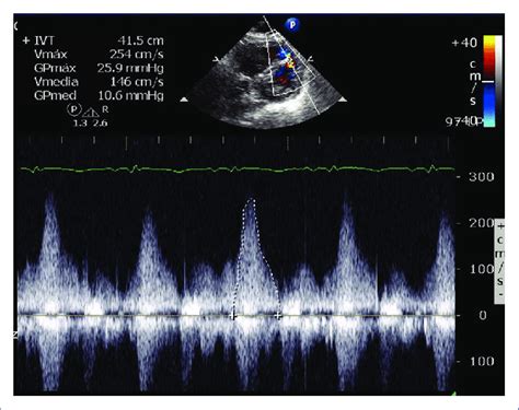 Two Dimensional Transthoracic Echocardiogram With Color Doppler Showing