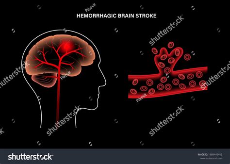 Hemorrhagic Brain Stroke Concept Apoplexy Cerebral Stock Vector Royalty Free 1999445405