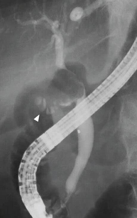 Ercp On Admission Ercp Revealed A Round Filling Defect Of The Bile Download Scientific Diagram