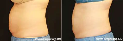 CoolSculpting Franklin TN Franklin Skin And Laser Nashville