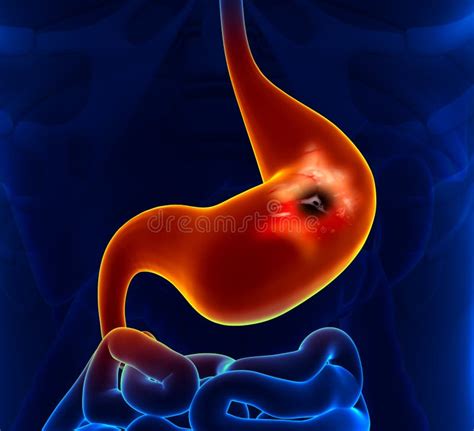 Peptic Ulcer Stomach Problem Stock Illustration Illustration Of