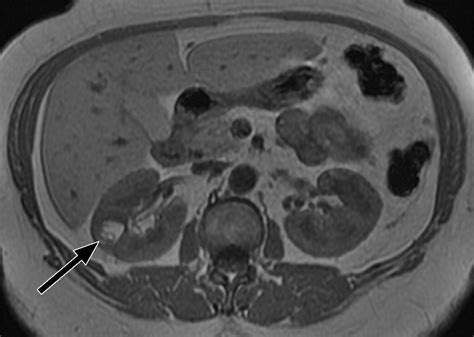 Comprehensive Imaging Manifestations Of Tuberous Sclerosis Ajr