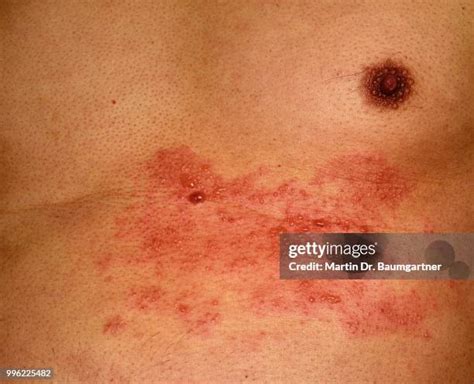 Shingles Rash Photos And Premium High Res Pictures Getty Images