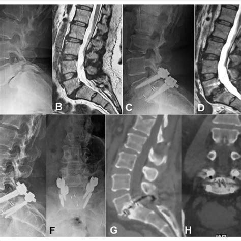 Images Of L Grade I Isthmic Spondylolisthesis A Sagittal T Wi