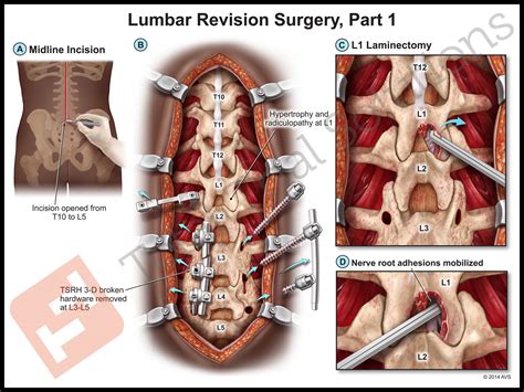 Medical Illustration | Lumbar Spine Injuries Followed By Multiple ...