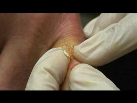 Finger Ganglion Cyst Drainage-HD - YouTube