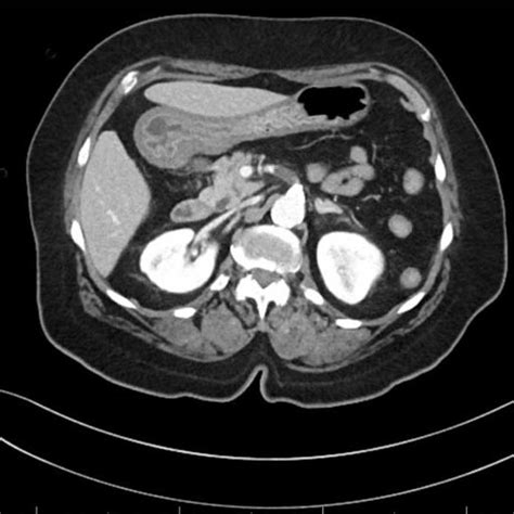 Ct Abdomen And Pelvis With Iv Contrast Axial Image Of 1 7 Cm Occlusive