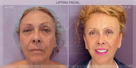 Faqs Despu S Del Lifting Facial Im Clinic