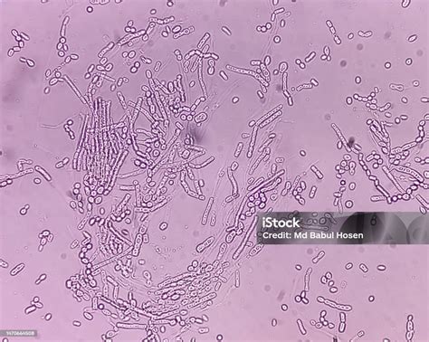 Microscopic Fungi Malassezia Furfur Showing Yeast Cells And Hyphae Dermatophytes Nail Scraping