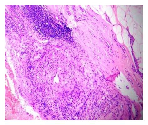 Case 2 Biopsy From Skin Lesion Showing Epithelioid Granuloma In The