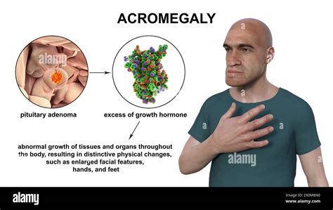 illustration   man  acromegaly    condition causing