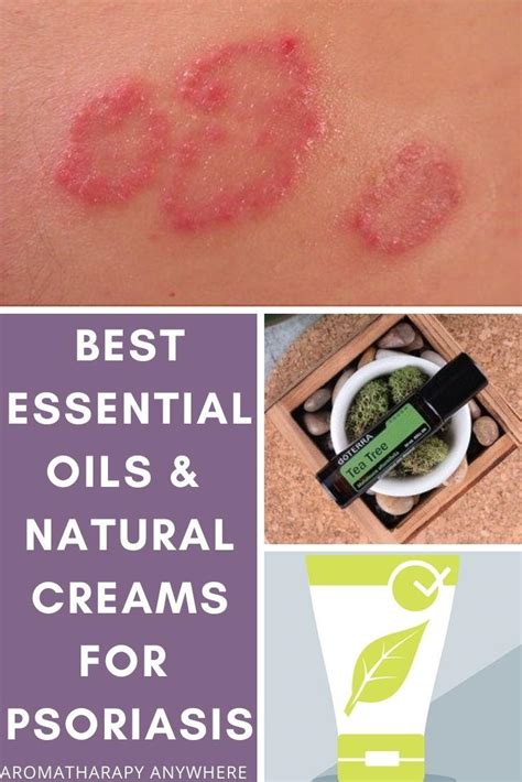 Best Essential Oils for Psoriasis + Natural Skin Cream Alternatives ...