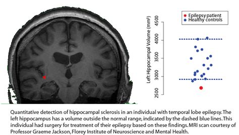 Computing on the brain: where MRI meets epilepsy treatment