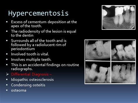 Differential Diagnosis Of Periapical Radiopacities Ppt Video Online