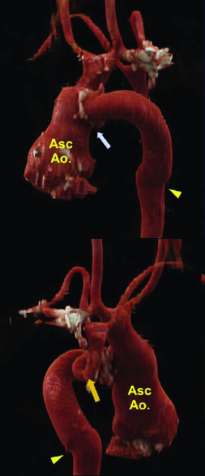 Aortic Arch Reconstruction The Aorta Was Reconstructed With A Mm