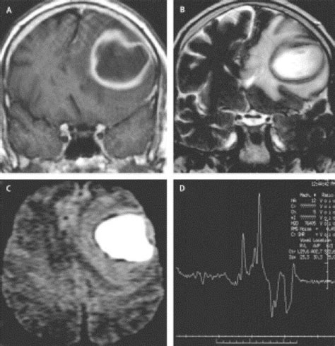 Pitfalls In The Diagnosis Of Brain Tumours The Lancet Neurology