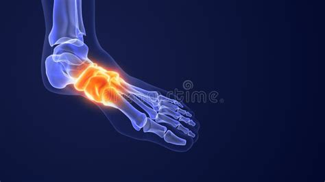 Pain from Aching Feet and Fallen Arches Stock Illustration - Illustration of trauma, medical ...