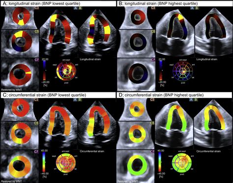 Three Dimensional Speckle Tracking Echocardiography In Light Chain