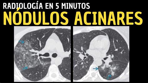 Radiolog A En Minutos Signos Radiol Gicos Pulmonares N Dulos