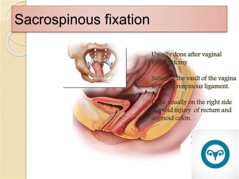 Surgical Management Of Uterine And Vault Recurrent Prolapse Ppt