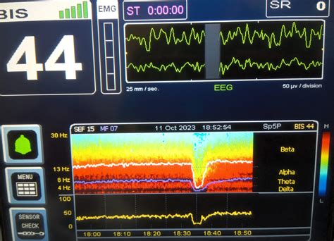 Intraoperative Burst Suppression On Electroencephalographic Density