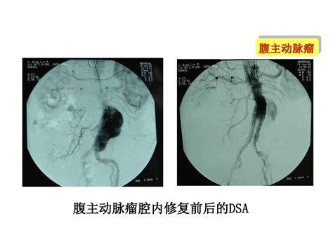 腹主动脉瘤 Ppt Download