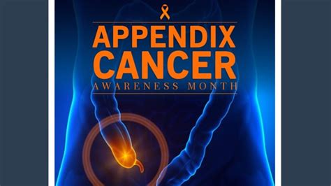 Appendix Cancer Awareness Month 2022: Causes, symptoms and tips on how ...