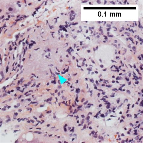 Primary Biliary Cholangitis Libre Pathology