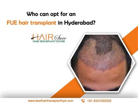 Who Can Opt For An Fue Hair Transplant In Hyderabad