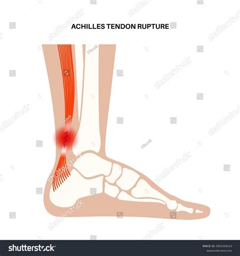 1,407 Ankle sprain anatomy Images, Stock Photos & Vectors | Shutterstock