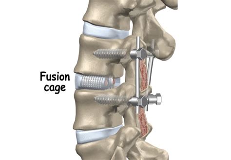 Posterior Lumbar Interbody Fusion Brain And Spine P C Brain And Spine Long Island Dr