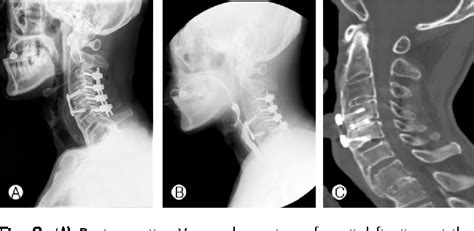 Cervical Osteophytes And Swallowing