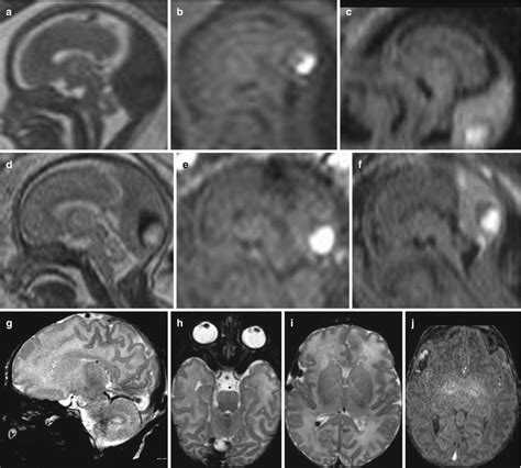 Vascular Malformations Radiology Key