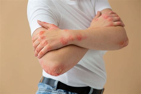 Understanding Staphylococcal Scalded Skin Syndrome Common Symptoms And