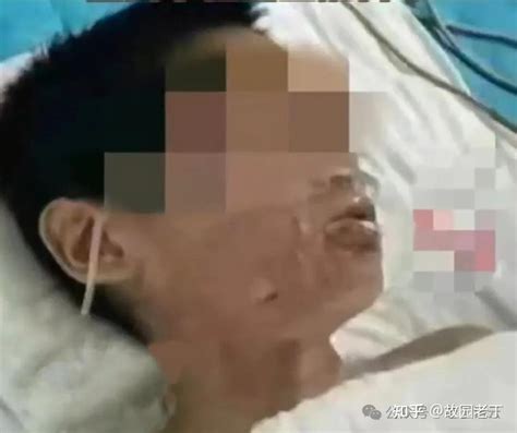 校园恶性霸凌又现河北邯郸？！一男生竟遭同学嘴里灌开水致严重烫伤！ 知乎