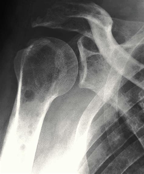 Secondary Bone Cancer Photograph by Zephyr/science Photo Library - Pixels