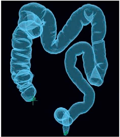 Ulcerative rectocolitis in the left colon with diffuse loss of haustra... | Download Scientific ...