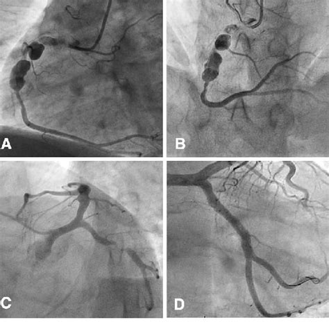 N Ammonia Pet Ct Mpi Apical Inferior And Inferoseptal Severe