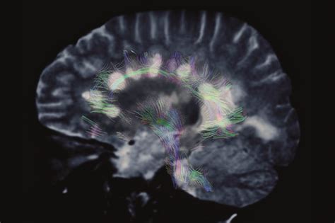 Tizanidine interactions - The Pharmaceutical Journal