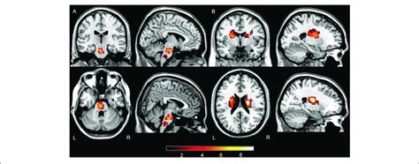 Summation Maps Of Lesion Distribution A Lesion Distributions In PS