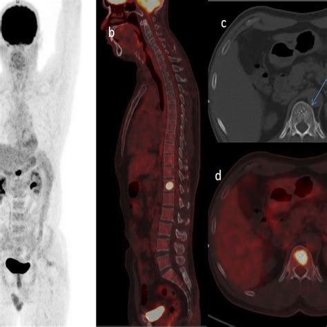 PDF False Positive FDG PET CT Scan In Vertebral Hemangioma