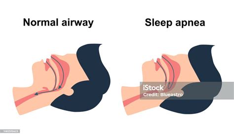 폐쇄성 수면 무호흡 증후군 개념 벡터 그림 수면중무호흡증에 대한 스톡 벡터 아트 및 기타 이미지 수면중무호흡증