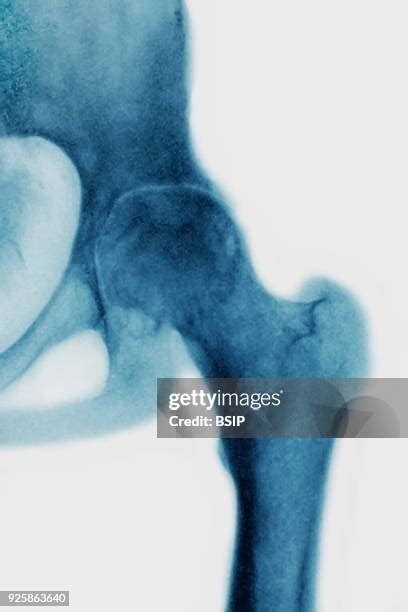 Hip Arthritis X Ray Photos and Premium High Res Pictures - Getty Images