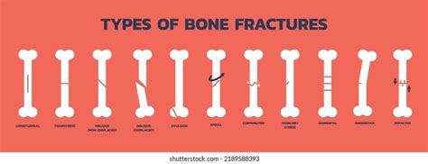 Types Bone Fractures Vector Illustration On Stock Vector Royalty Free