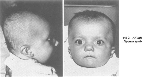 Figure 2 From Noonan Syndrome Fig 4 An Adolescent With Noonan Syndrome