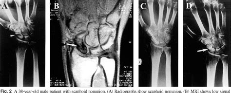 Figure 2 From Management Of Scaphoid Nonunion With Avascular Necrosis